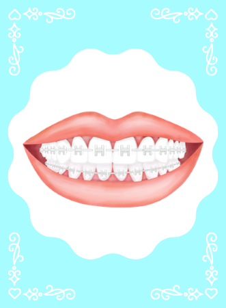 Conventional Braces