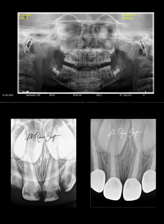 Digital xray