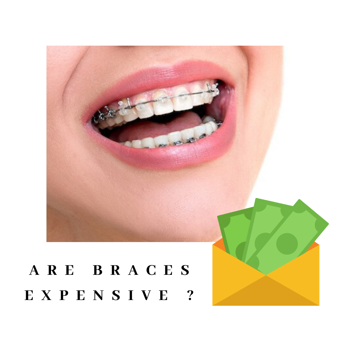 Are Braces Expensive?