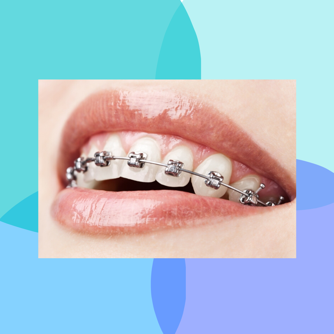 Are Braces Painful?