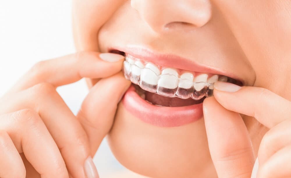 Do Removable Braces Work ?