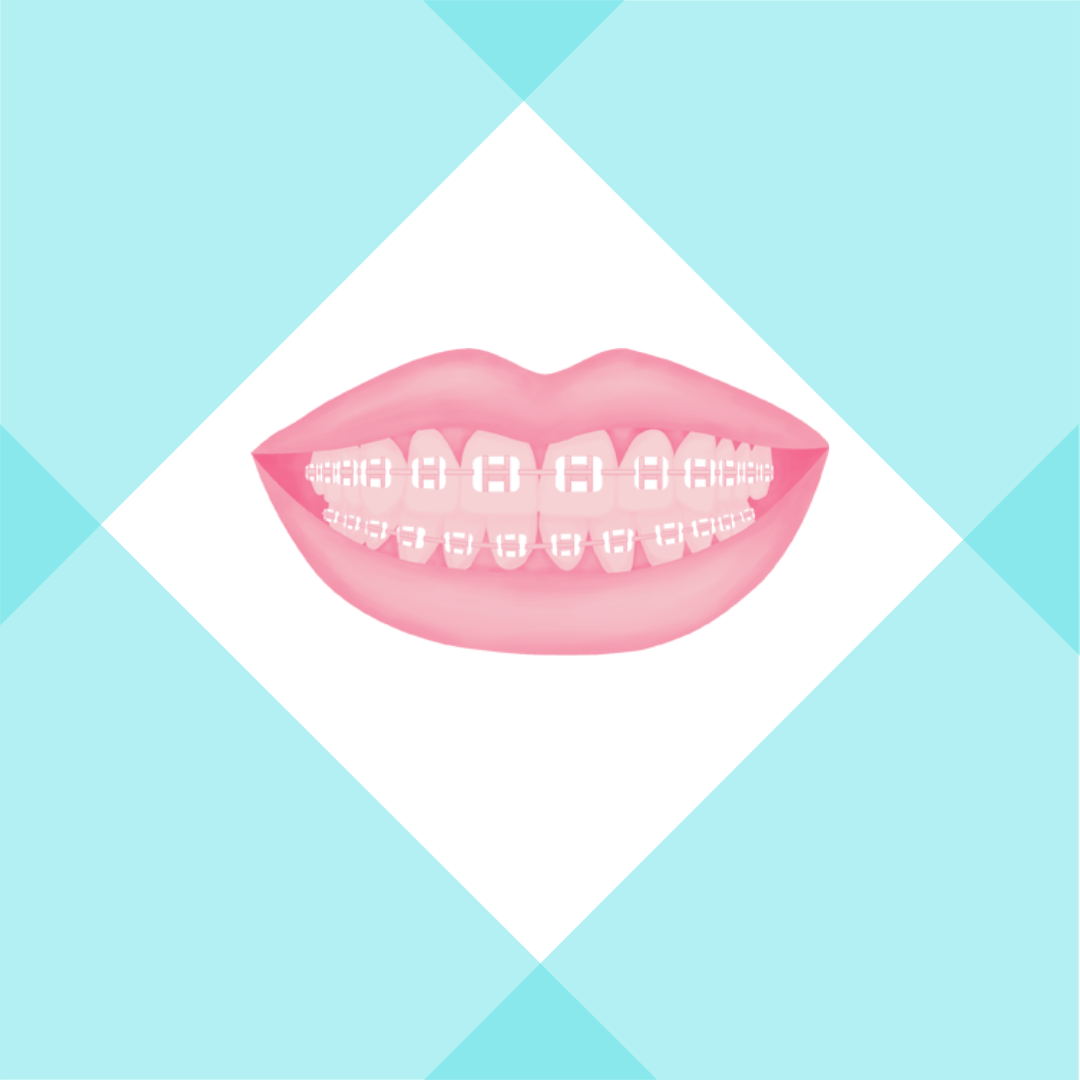 What to expect before getting braces ?