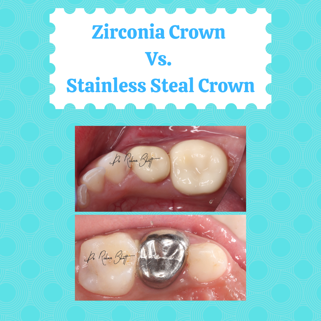 Zirconia Crown Vs Stainless Steal Crown