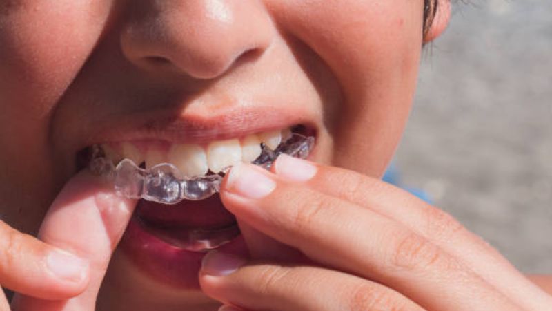 Aligners